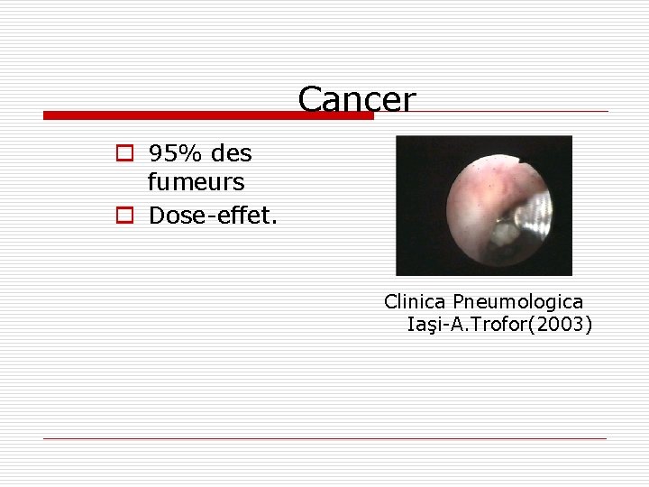 Cancer o 95% des fumeurs o Dose-effet. Clinica Pneumologica Iaşi-A. Trofor(2003) 