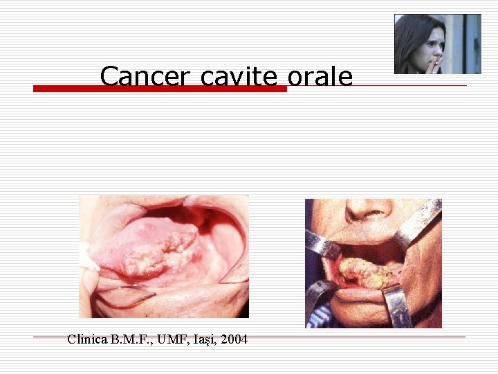 Cancer cavite orale Clinica B. M. F. , UMF, Iaşi, 2004 