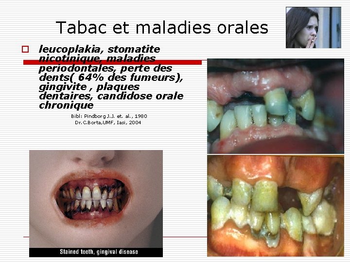 Tabac et maladies orales o leucoplakia, stomatite nicotinique, maladies periodontales, perte des dents( 64%