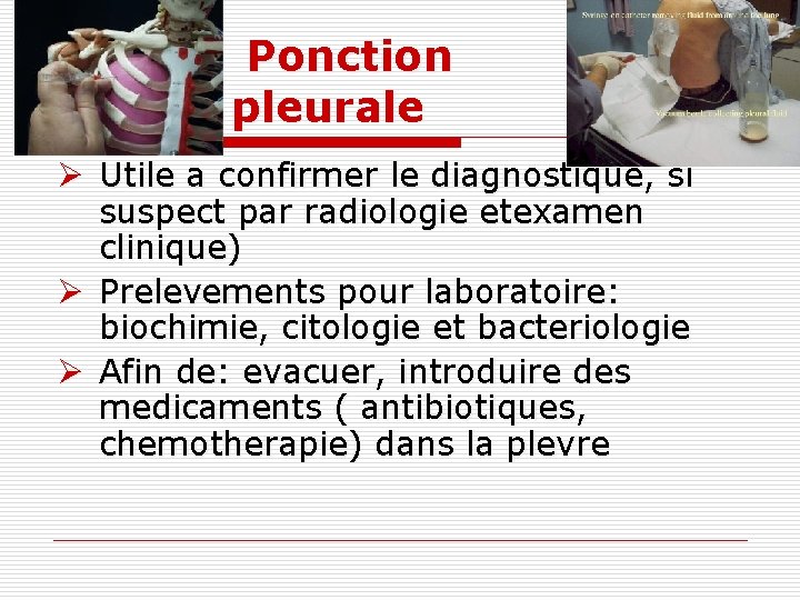 Ponction pleurale Ø Utile a confirmer le diagnostique, si suspect par radiologie etexamen clinique)