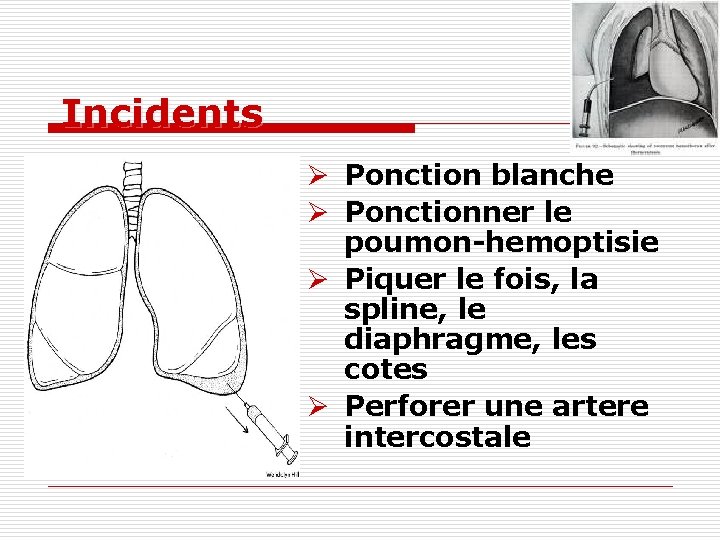 Incidents Ø Ponction blanche Ø Ponctionner le poumon-hemoptisie Ø Piquer le fois, la spline,