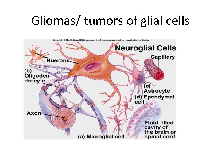 Gliomas/ tumors of glial cells 