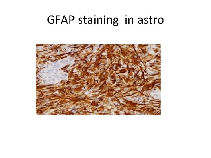 GFAP staining in astro 