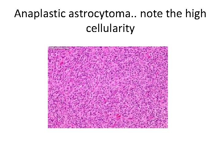 Anaplastic astrocytoma. . note the high cellularity 