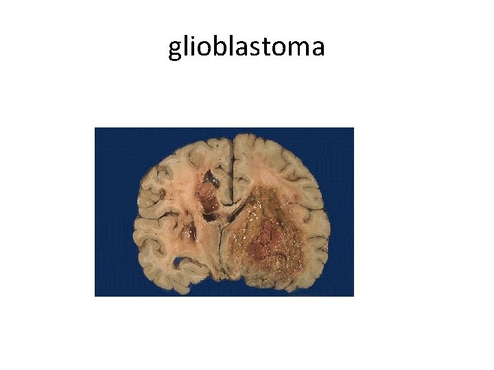 glioblastoma 