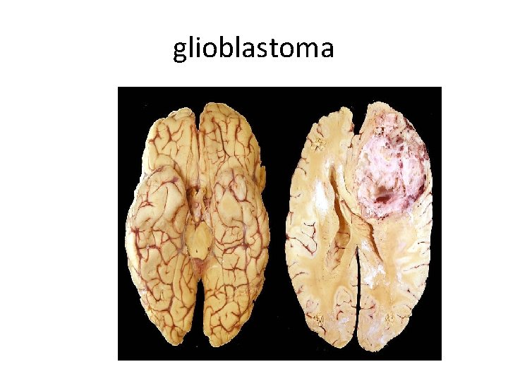 glioblastoma 