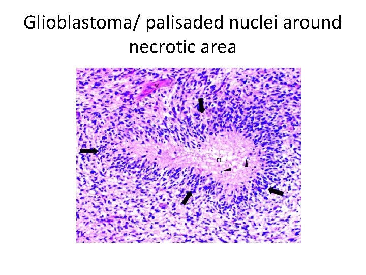 Glioblastoma/ palisaded nuclei around necrotic area 