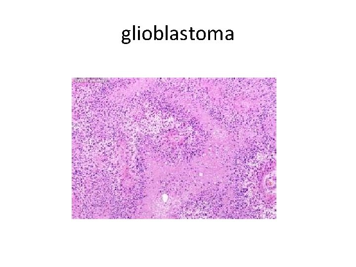 glioblastoma 