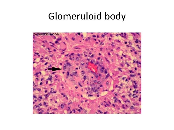Glomeruloid body 