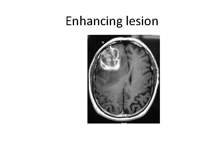 Enhancing lesion 