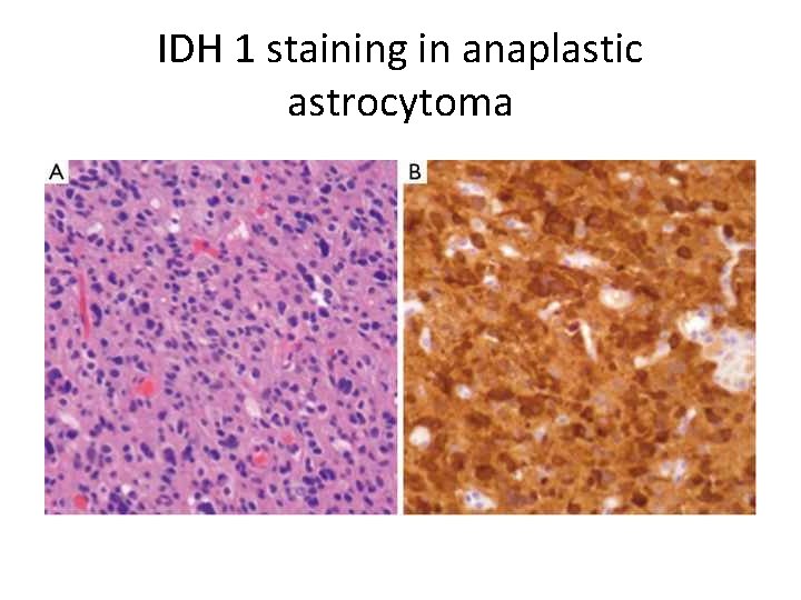 IDH 1 staining in anaplastic astrocytoma 