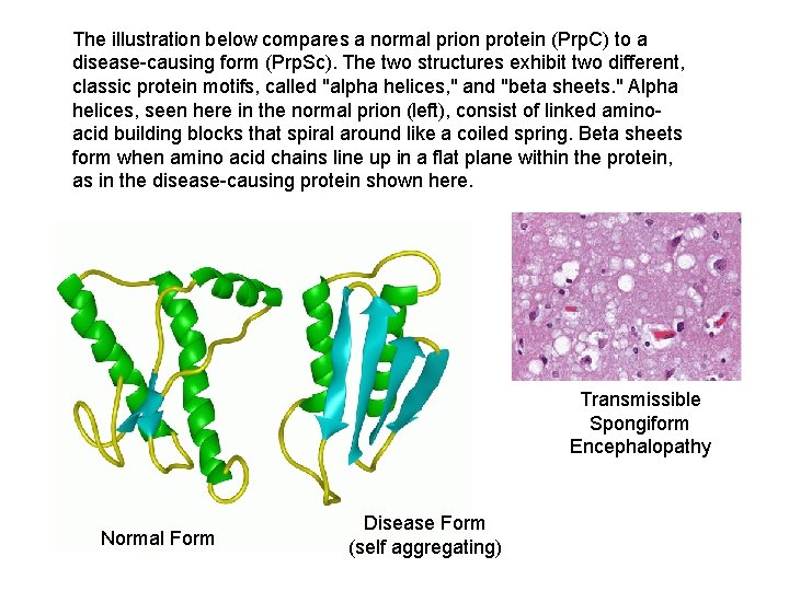 The illustration below compares a normal prion protein (Prp. C) to a disease-causing form