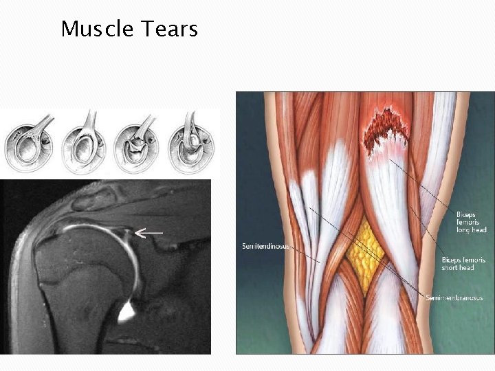 Muscle Tears Injuries: Part 2 