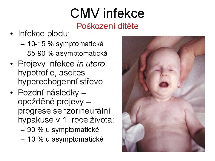 CMV infekce • Infekce plodu: Poškození dítěte – 10 -15 % symptomatická – 85