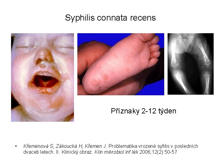Syphilis connata recens Příznaky 2 -12 týden • Křemenová S, Zákoucká H, Křemen J.