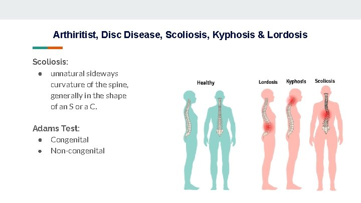 Arthiritist, Disc Disease, Scoliosis, Kyphosis & Lordosis Scoliosis: ● unnatural sideways curvature of the