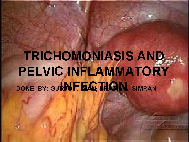 TRICHOMONIASIS AND PELVIC INFLAMMATORY DONE BY: GURJOT, IMAN, PRATIMA, SIMRAN INFECTION 