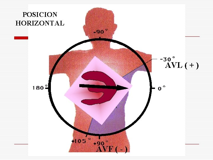 POSICION HORIZONTAL AVL ( + ) AVF ( - ) POSICION HORIZONTAL AVL ( + ) AVF ( - )