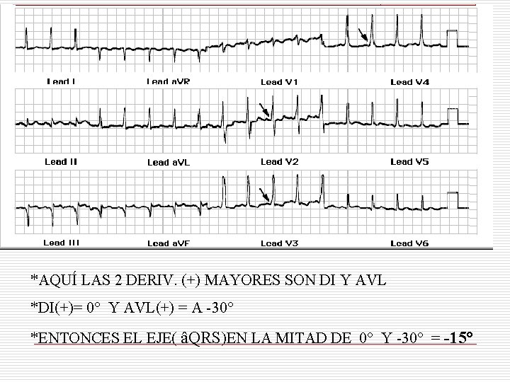 *AQUÍ LAS 2 DERIV. (+) MAYORES SON DI Y AVL *DI(+)= 0° Y AVL(+) *AQUÍ LAS 2 DERIV. (+) MAYORES SON DI Y AVL *DI(+)= 0° Y AVL(+)