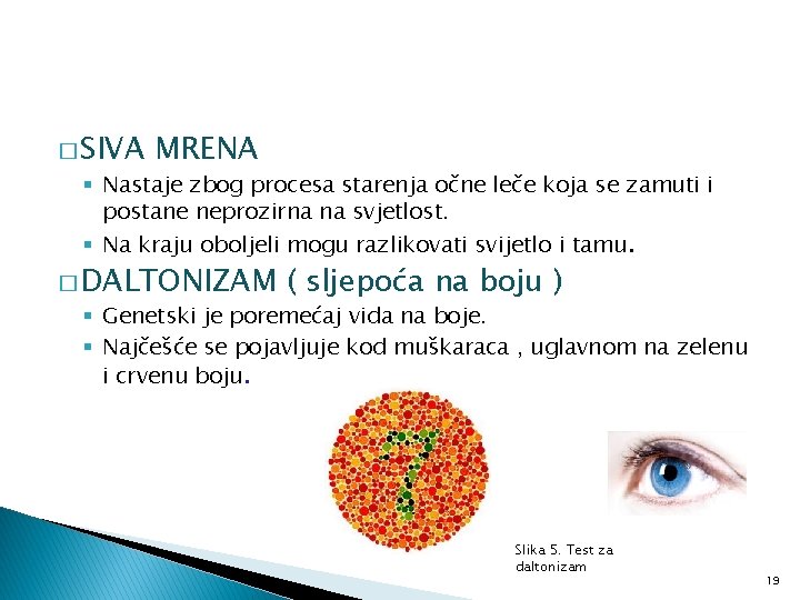 � SIVA MRENA § Nastaje zbog procesa starenja očne leče koja se zamuti i