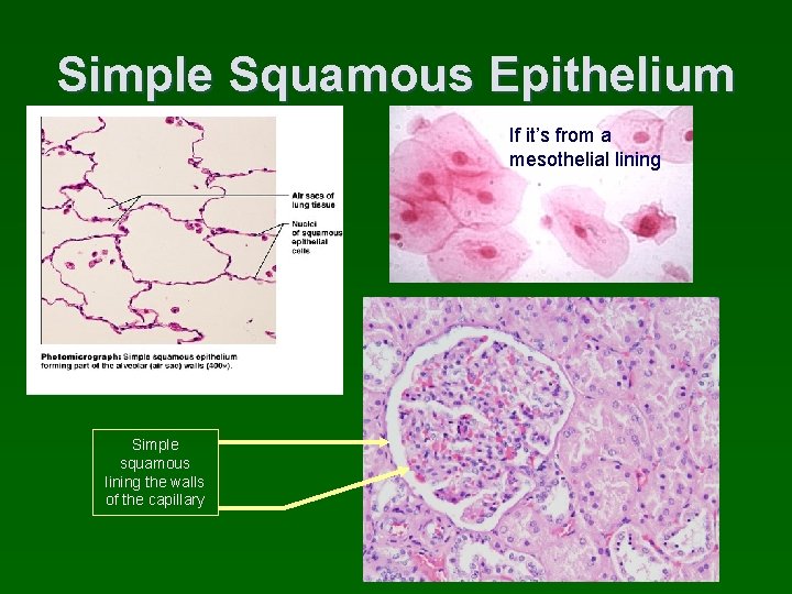 Simple Squamous Epithelium If it’s from a mesothelial lining Simple squamous lining the walls