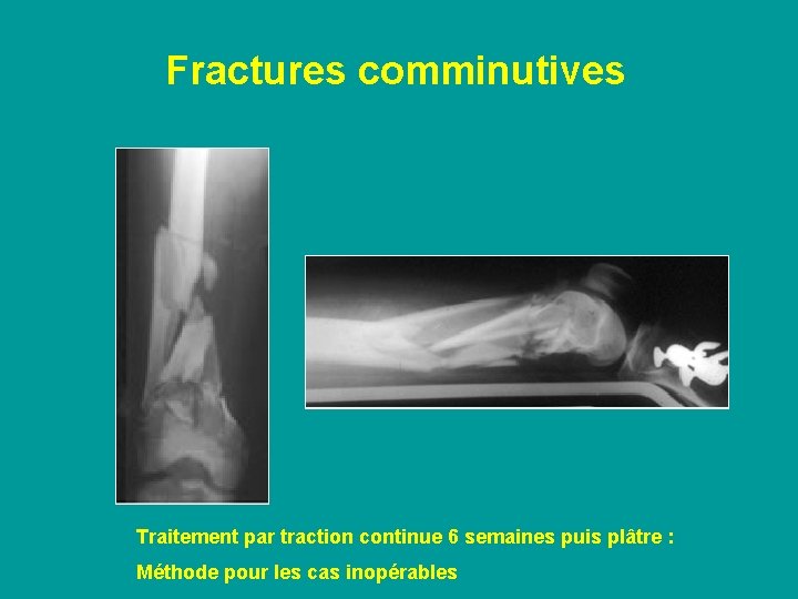 Fractures comminutives Traitement par traction continue 6 semaines puis plâtre : Méthode pour les