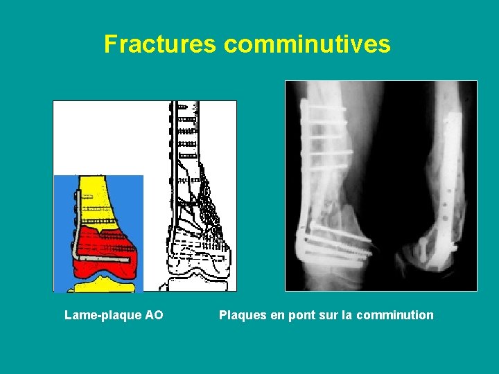 Fractures comminutives Lame-plaque AO Plaques en pont sur la comminution 