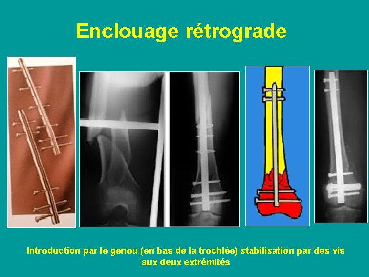 Enclouage rétrograde Introduction par le genou (en bas de la trochlée) stabilisation par des
