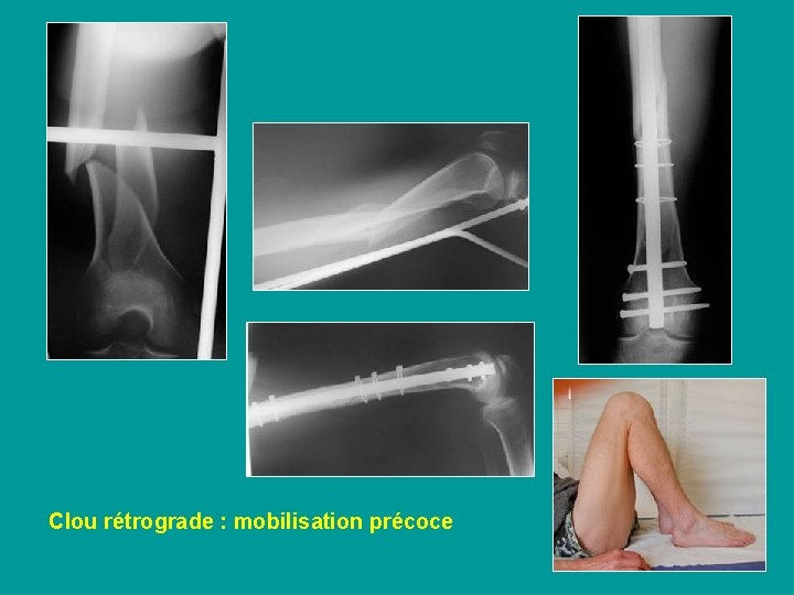 Clou rétrograde : mobilisation précoce 