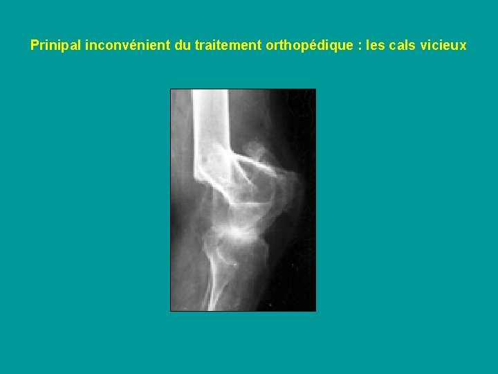 Prinipal inconvénient du traitement orthopédique : les cals vicieux 