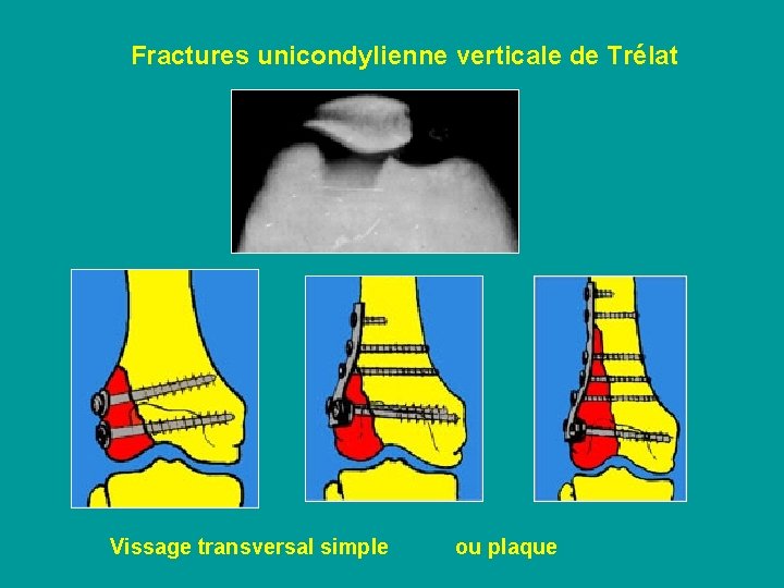 Fractures unicondylienne verticale de Trélat Vissage transversal simple ou plaque 
