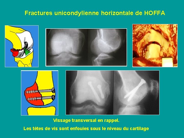 Fractures unicondylienne horizontale de HOFFA Vissage transversal en rappel. Les têtes de vis sont