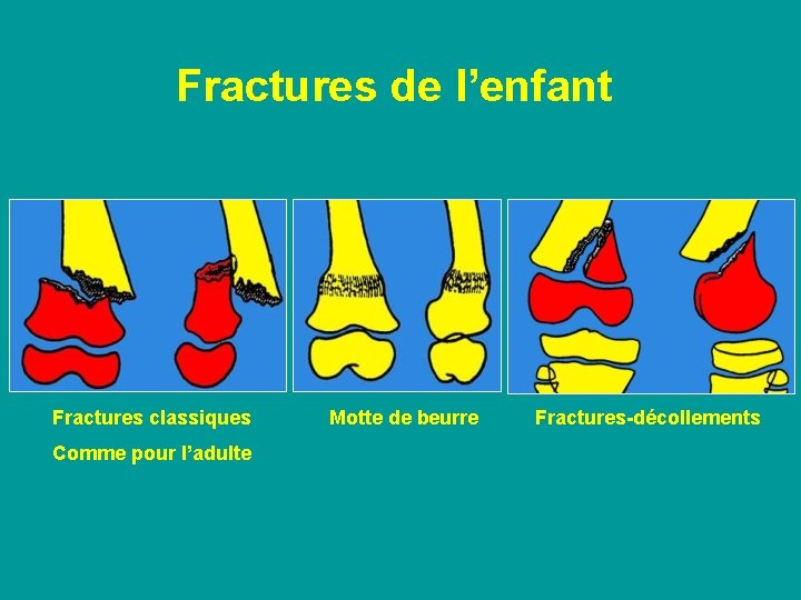 Fractures de l’enfant Fractures classiques Comme pour l’adulte Motte de beurre Fractures-décollements 