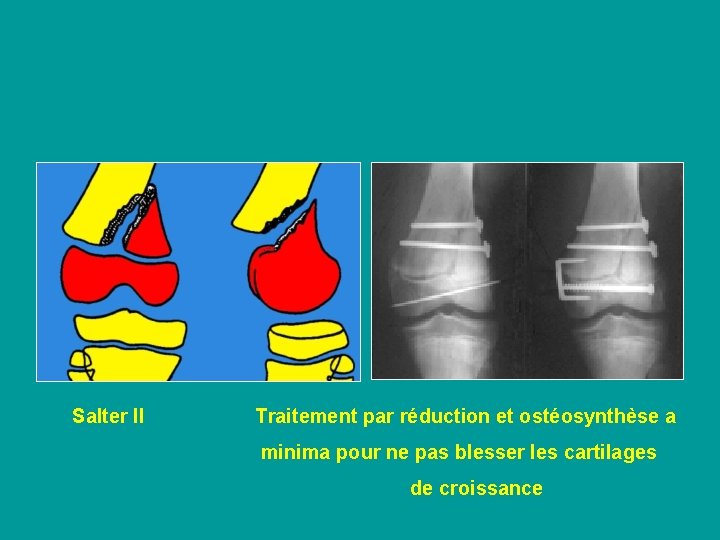 Salter II Traitement par réduction et ostéosynthèse a minima pour ne pas blesser les