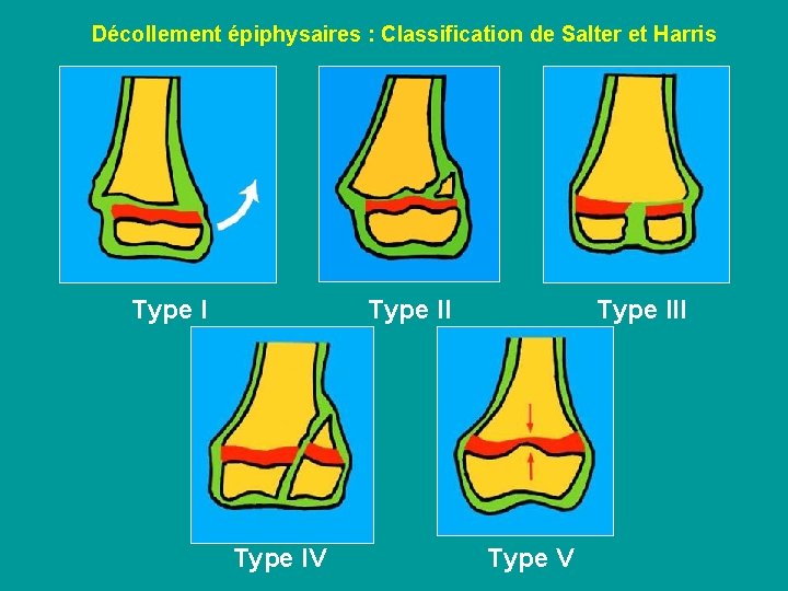 Décollement épiphysaires : Classification de Salter et Harris Type II Type IV Type III