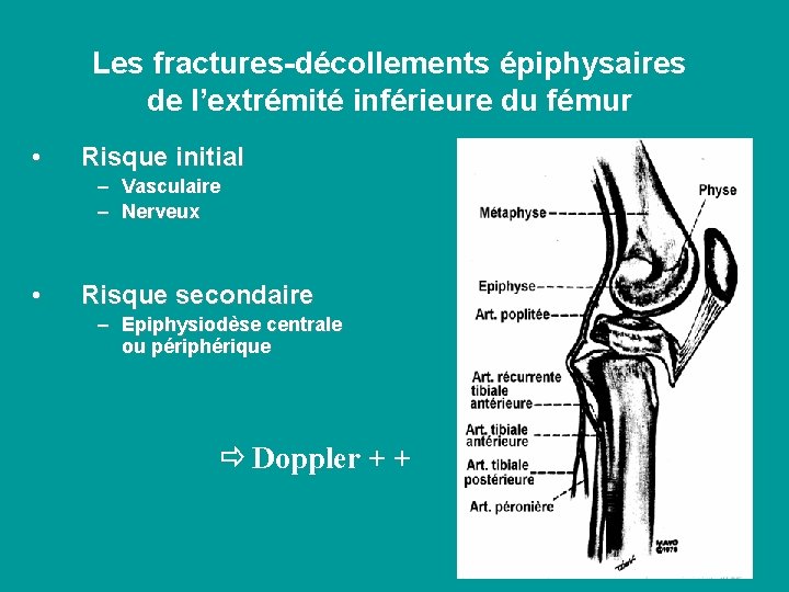 Les fractures-décollements épiphysaires de l’extrémité inférieure du fémur • Risque initial – – •