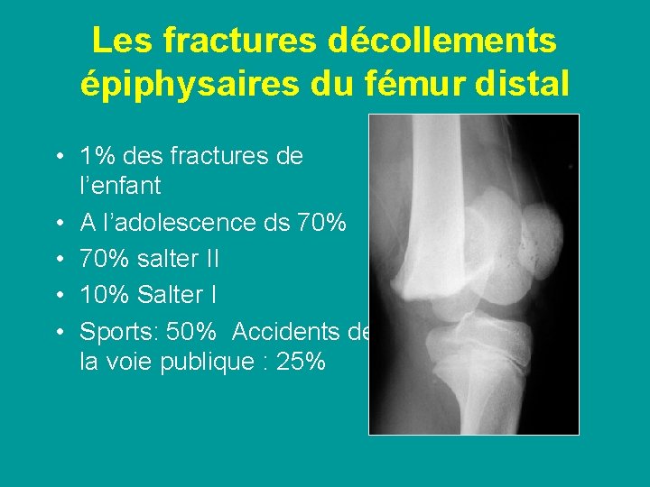 Les fractures décollements épiphysaires du fémur distal • 1% des fractures de l’enfant •