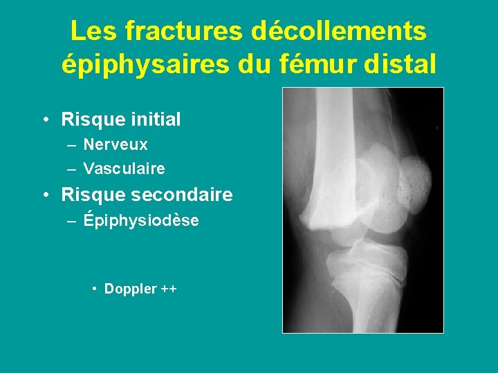 Les fractures décollements épiphysaires du fémur distal • Risque initial – Nerveux – Vasculaire