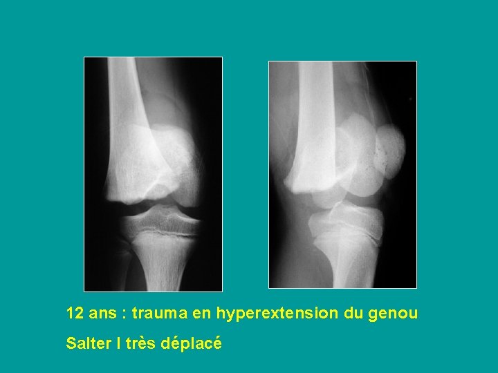 12 ans : trauma en hyperextension du genou Salter I très déplacé 