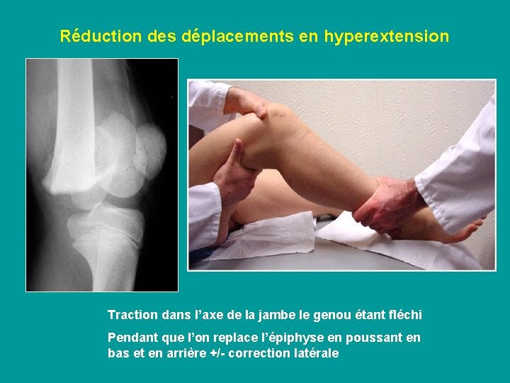 Réduction des déplacements en hyperextension Traction dans l’axe de la jambe le genou étant