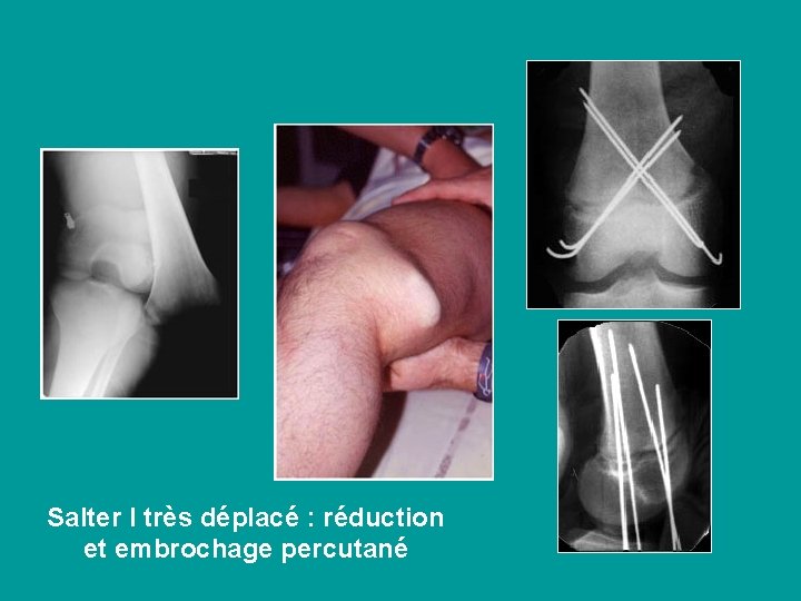 Salter I très déplacé : réduction et embrochage percutané 