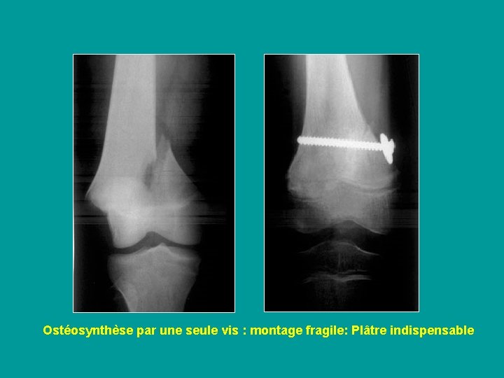 Ostéosynthèse par une seule vis : montage fragile: Plâtre indispensable 