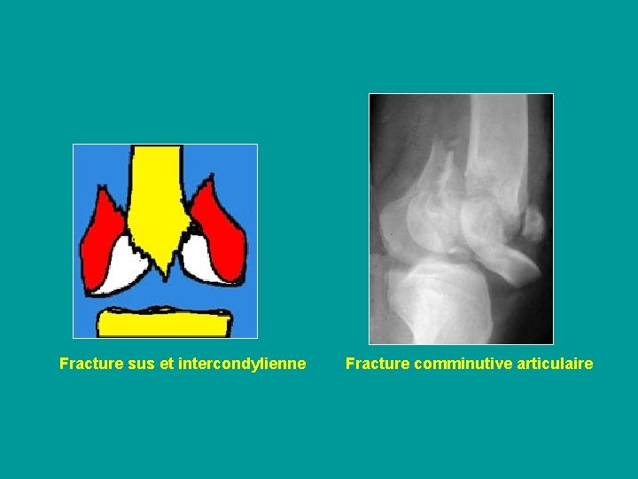 Fracture sus et intercondylienne Fracture comminutive articulaire 