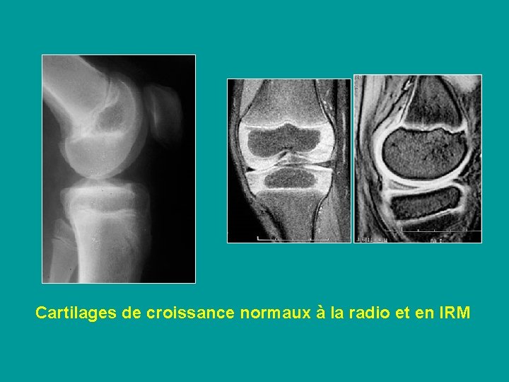 Cartilages de croissance normaux à la radio et en IRM 