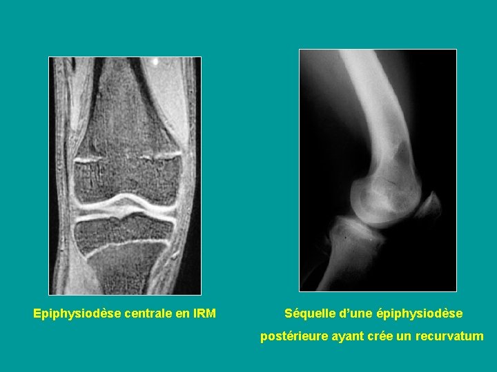 Epiphysiodèse centrale en IRM Séquelle d’une épiphysiodèse postérieure ayant crée un recurvatum 