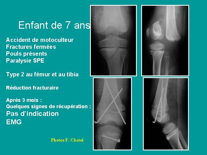 Enfant de 7 ans Accident de motoculteur Fractures fermées Pouls présents Paralysie SPE Type