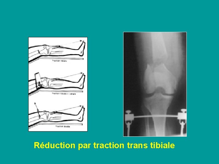 Réduction par traction trans tibiale 