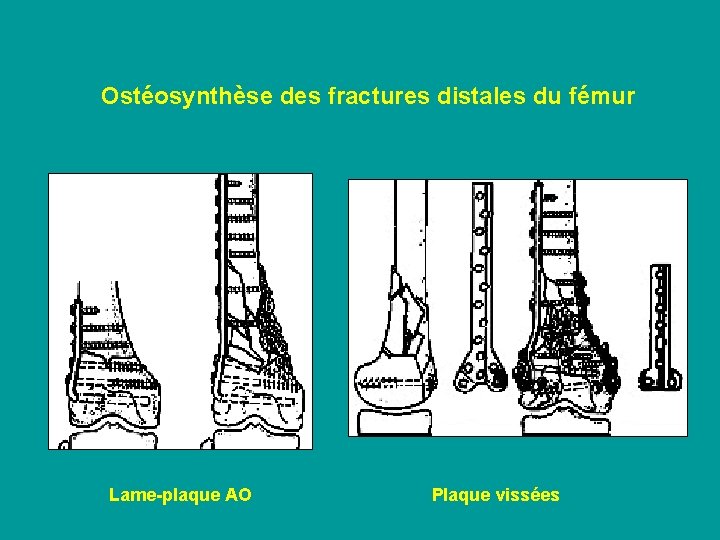 Ostéosynthèse des fractures distales du fémur Lame-plaque AO Plaque vissées 