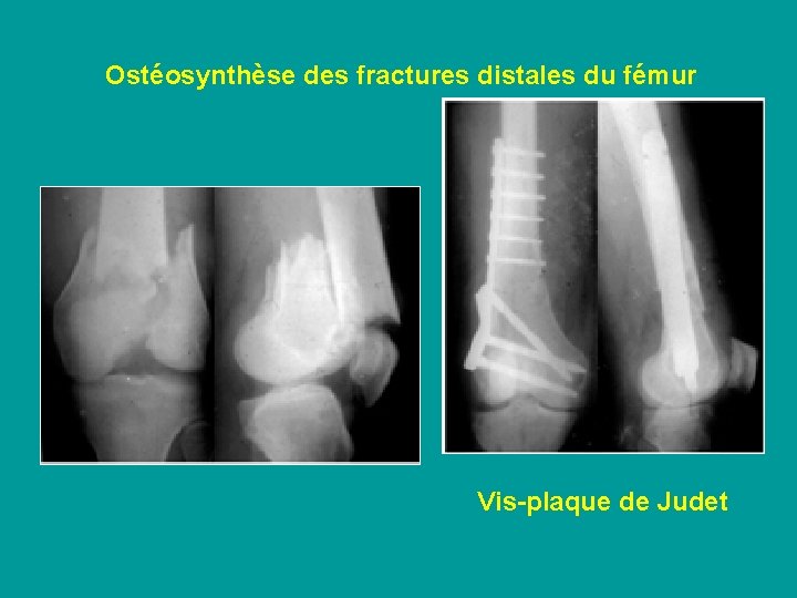 Ostéosynthèse des fractures distales du fémur Vis-plaque de Judet 