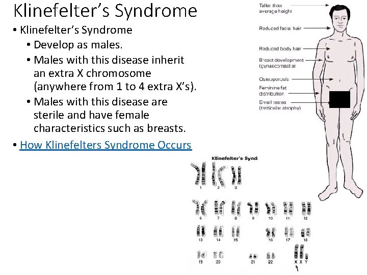 Klinefelter’s Syndrome • Develop as males. • Males with this disease inherit an extra